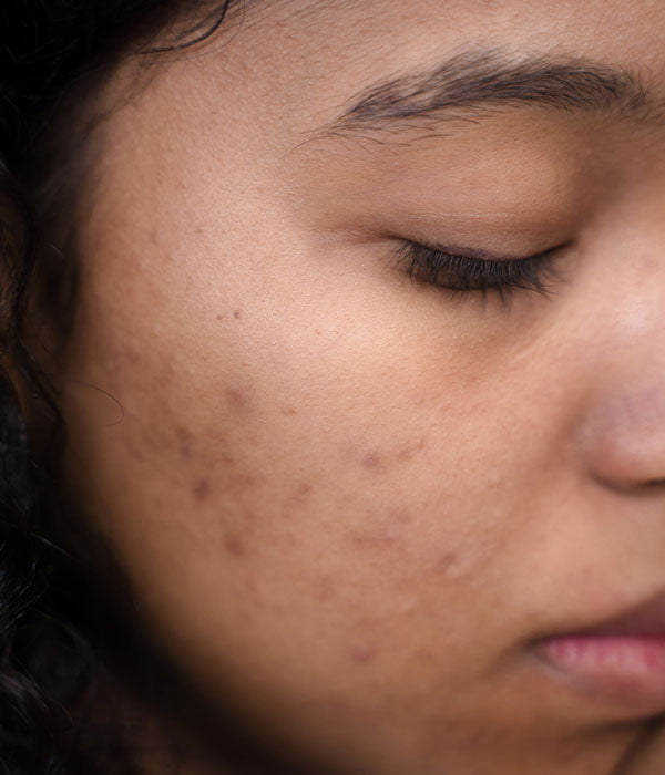 Tips for Managing and Preventing Acne